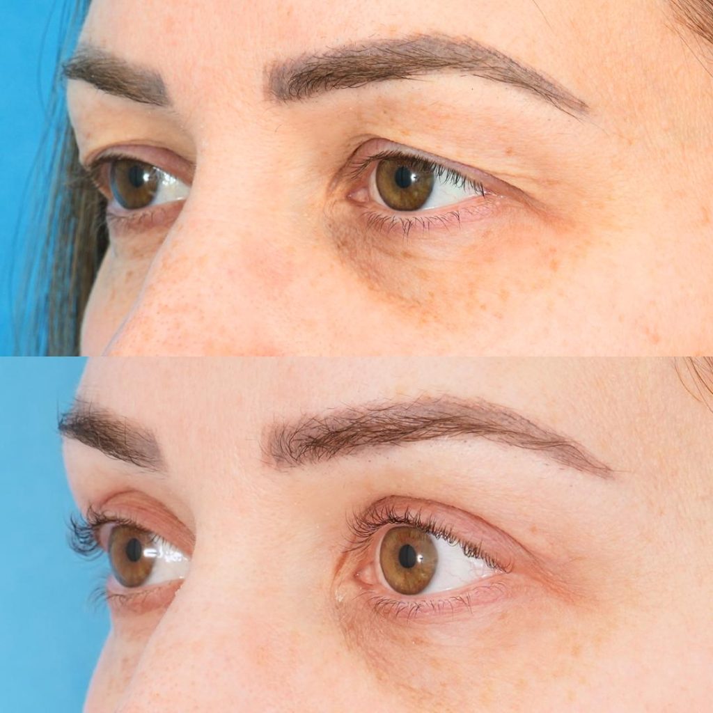 Blepharoplasty Result