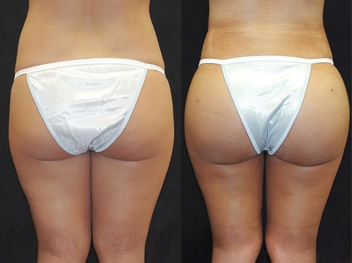 Brazilian Butt Lift (BBL) Result