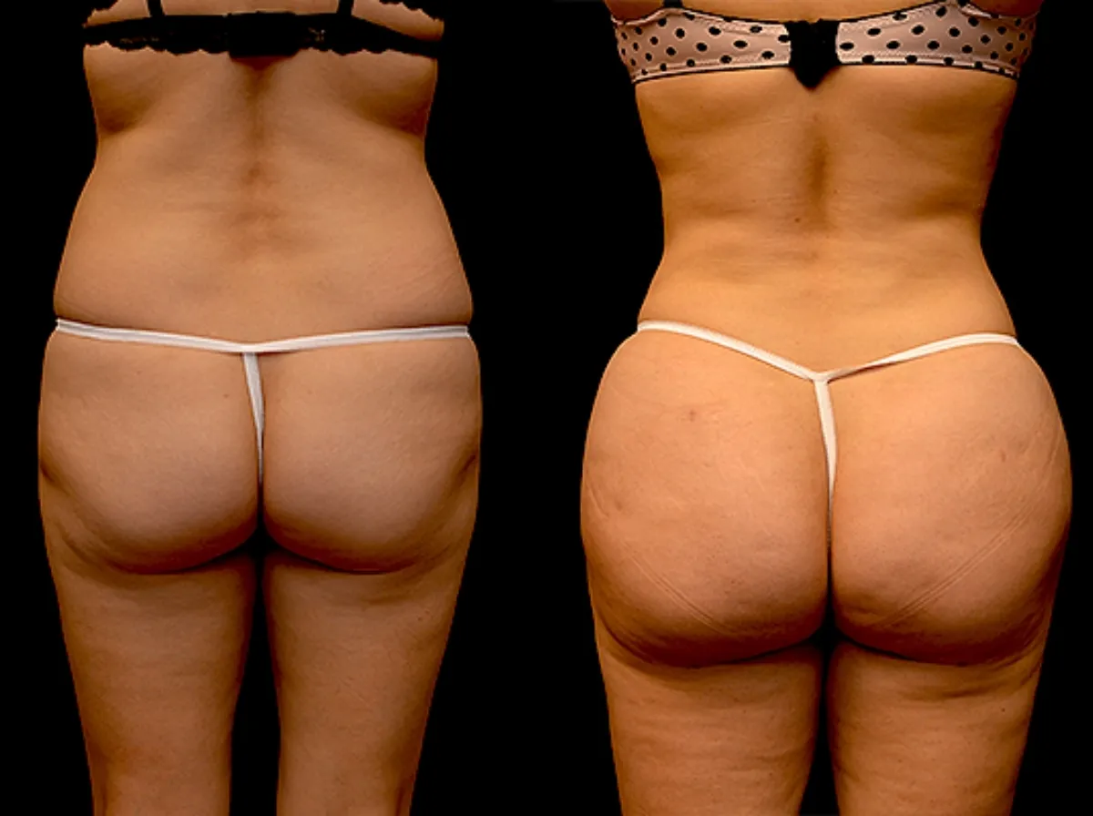 Brazilian Butt Lift (BBL) Result