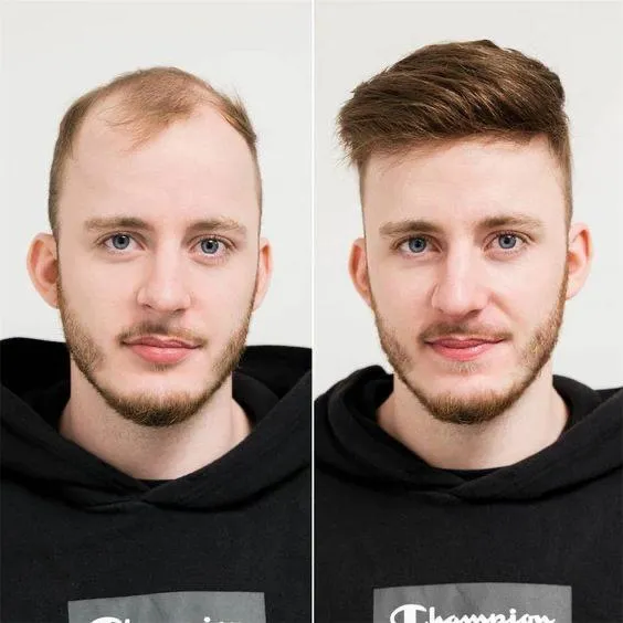 Hair Transplant Result