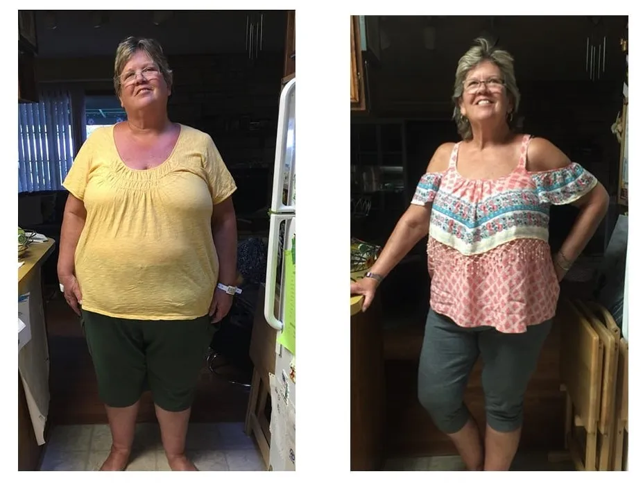 Gastric Sleeve Result