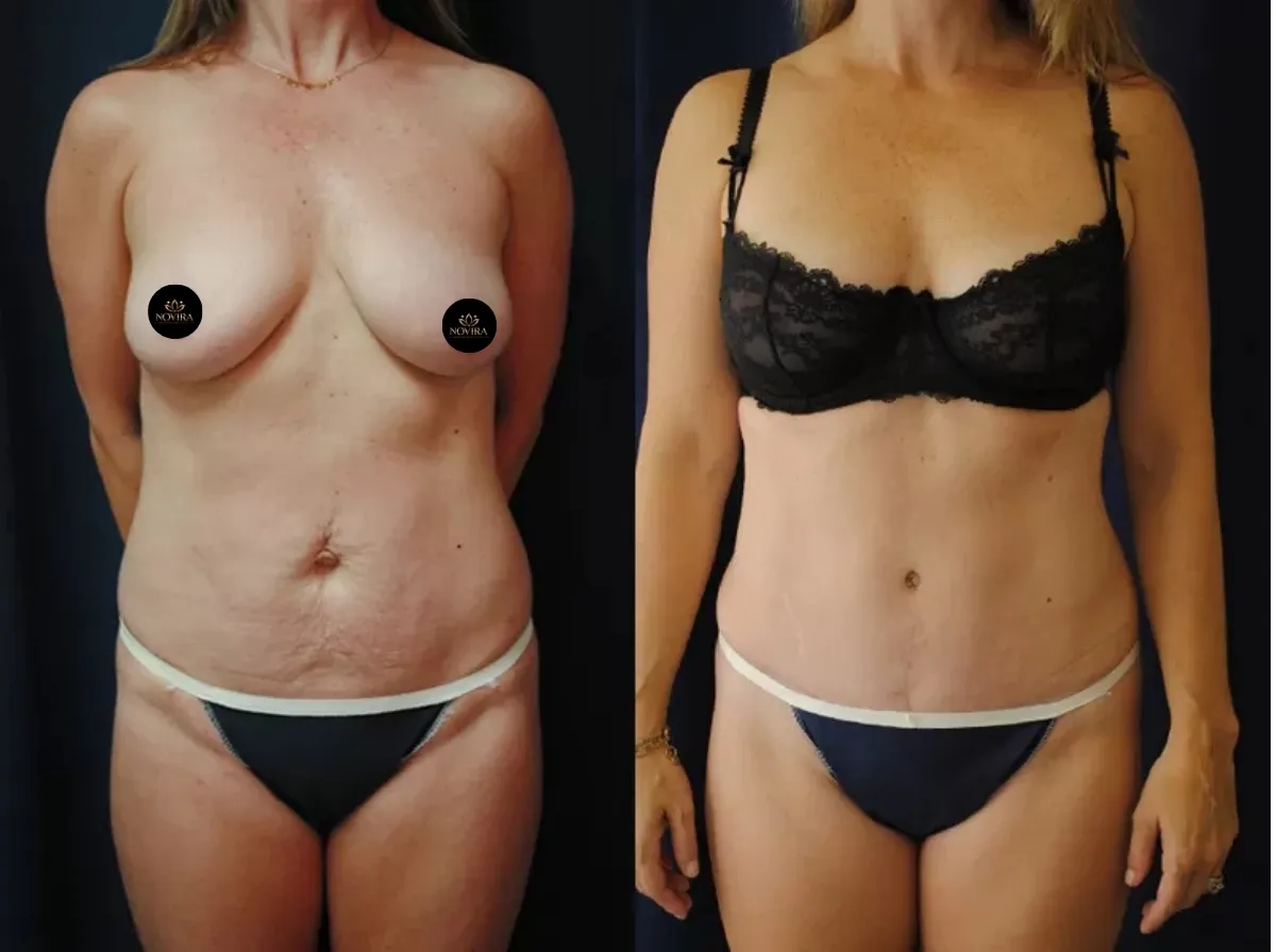 Abdominoplasty Result