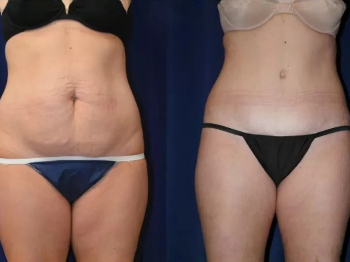 Abdominoplasty Result