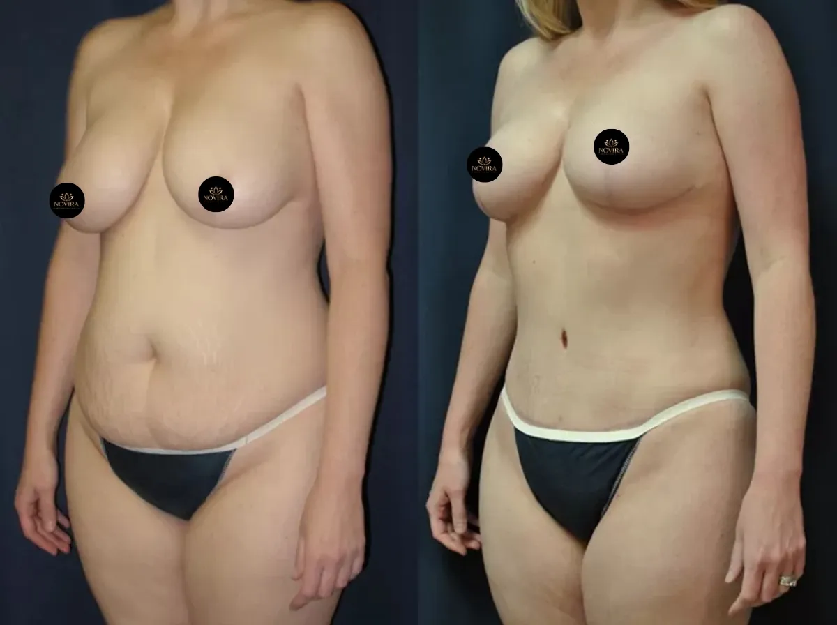 Abdominoplasty Result