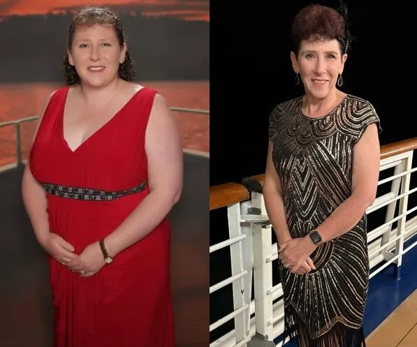 Gastric Bypass Result