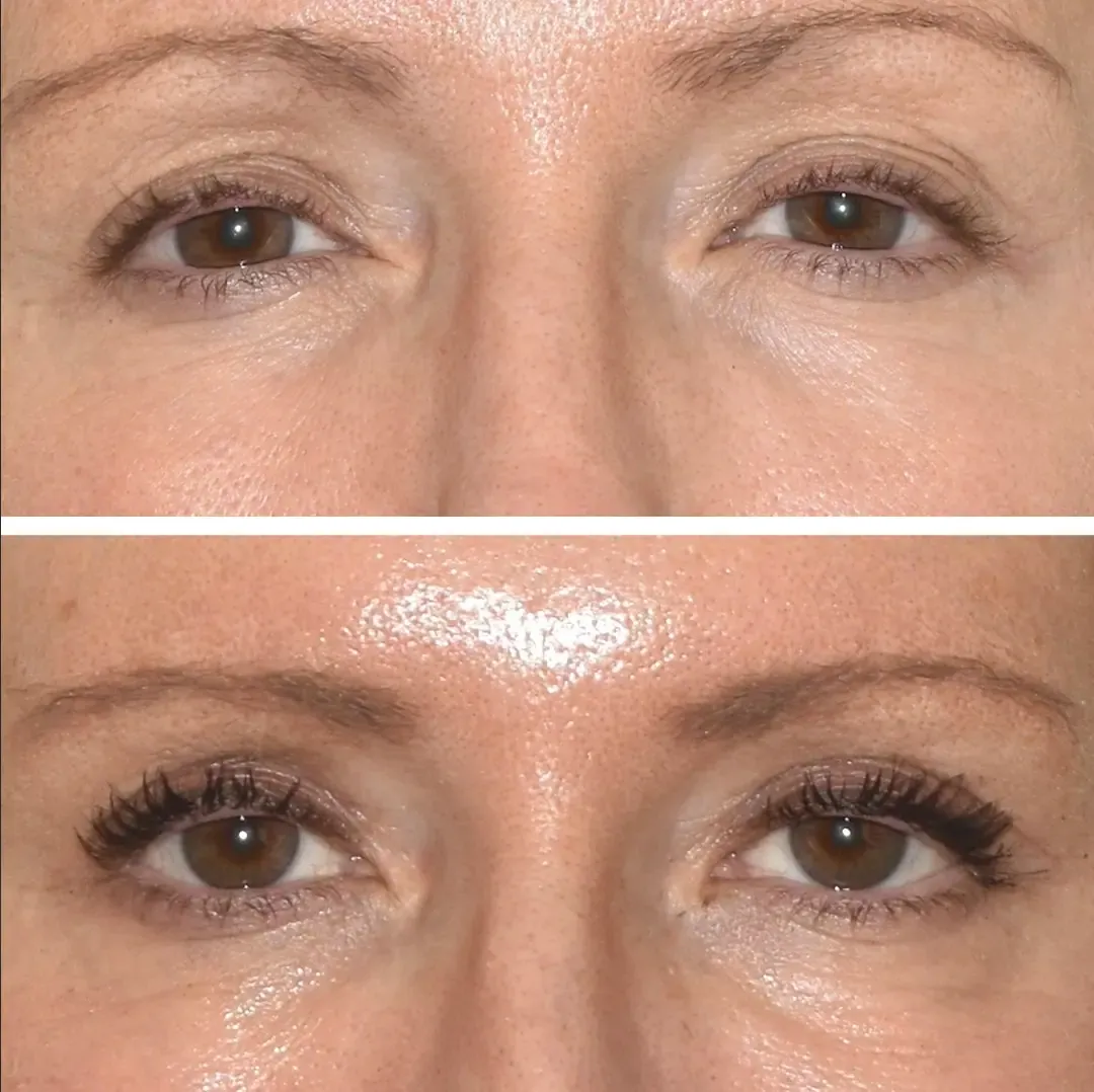 Blepharoplasty Result