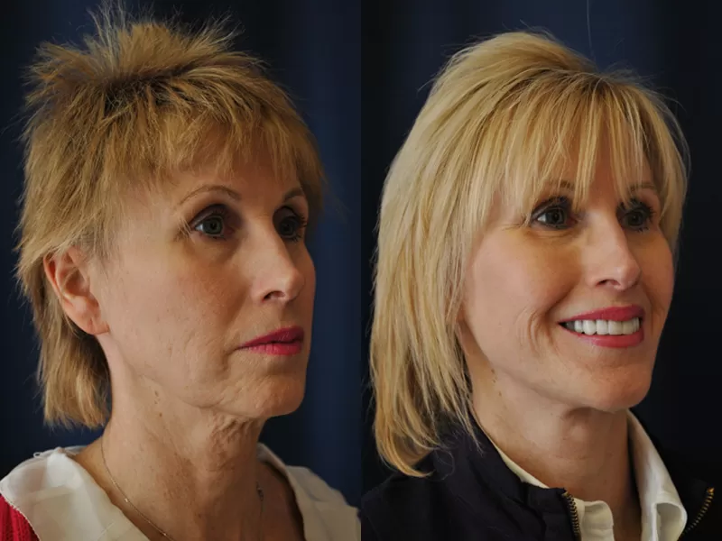 Facelift (Rhytidectomy) Result