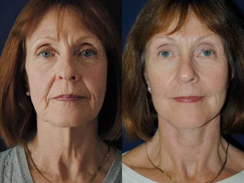 Facelift (Rhytidectomy) Result
