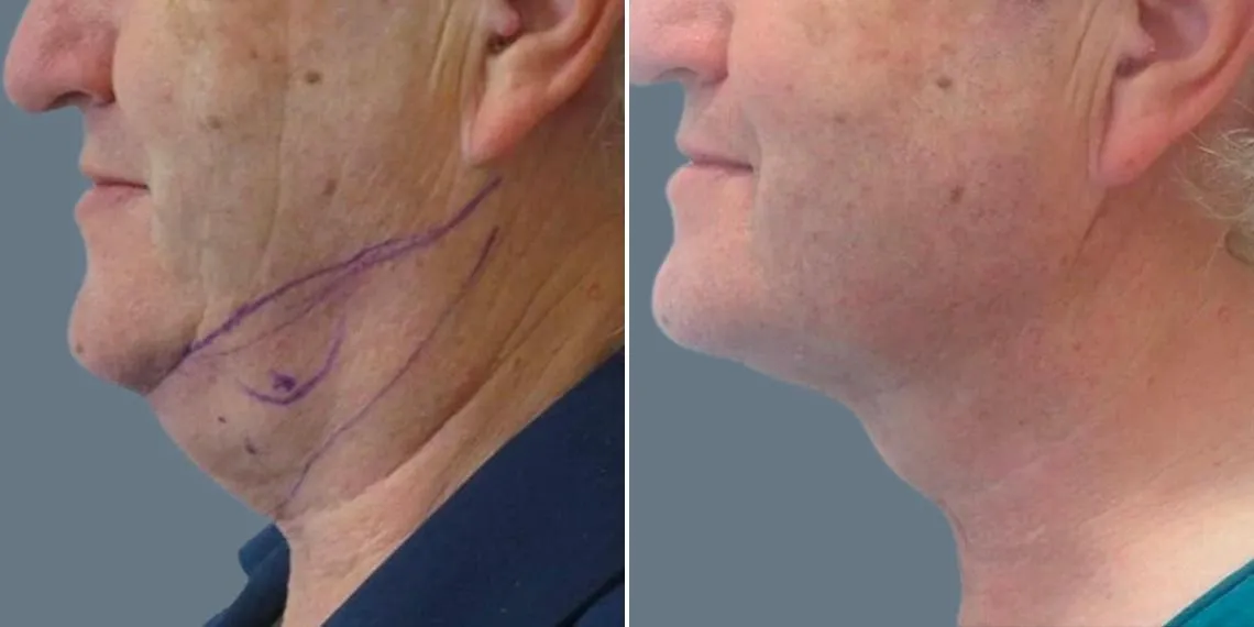 Neck Lift Result