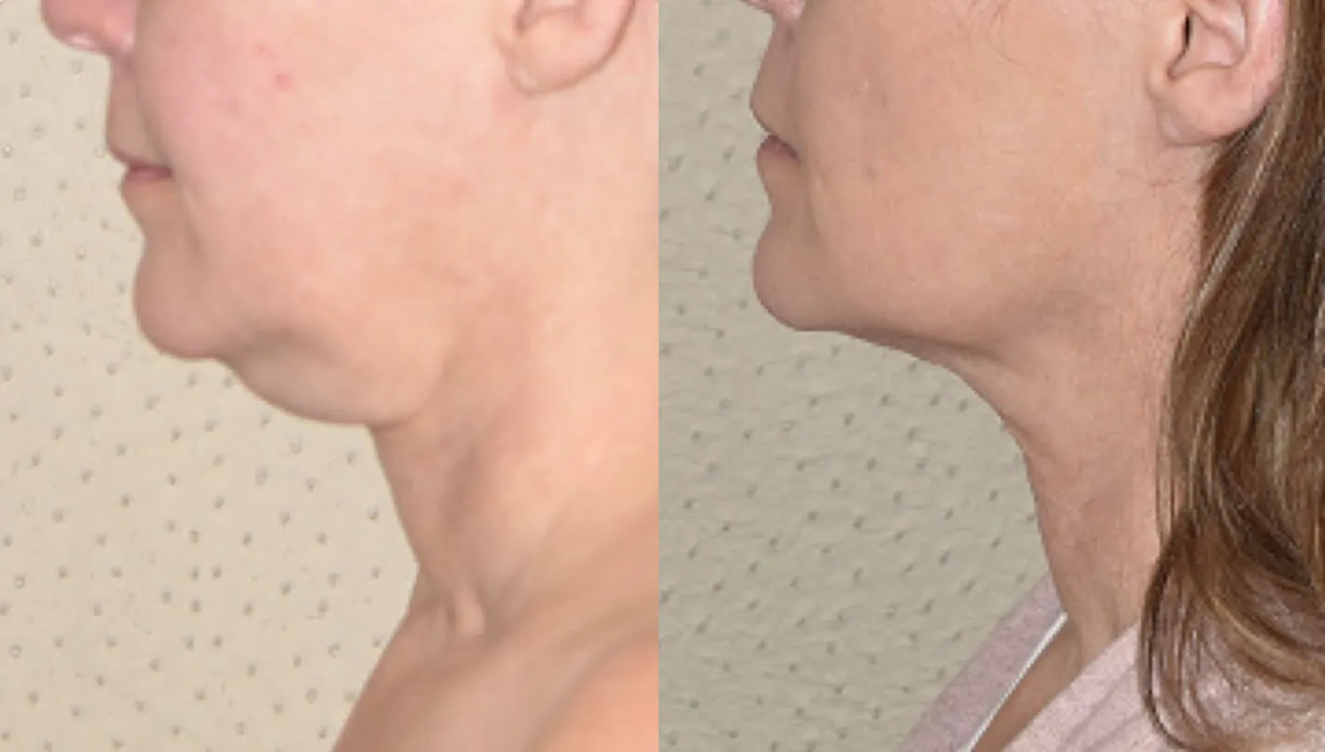 Neck Lift Result