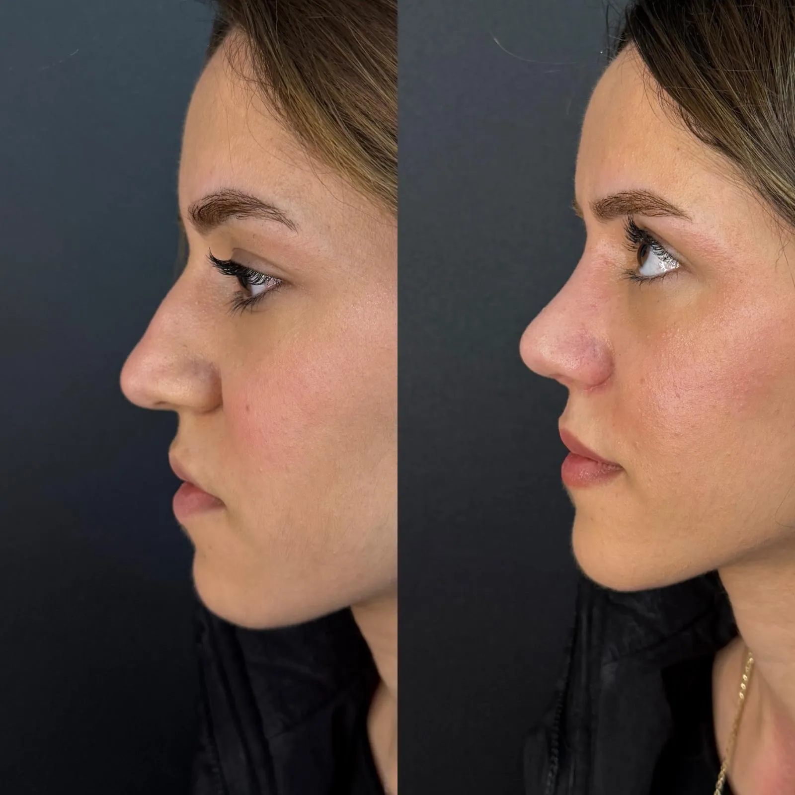 Rhinoplasty Result