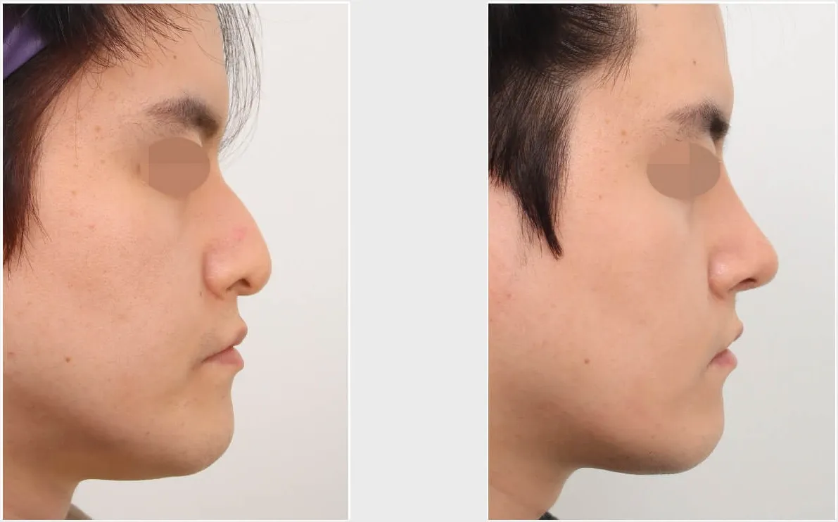 Rhinoplasty Result