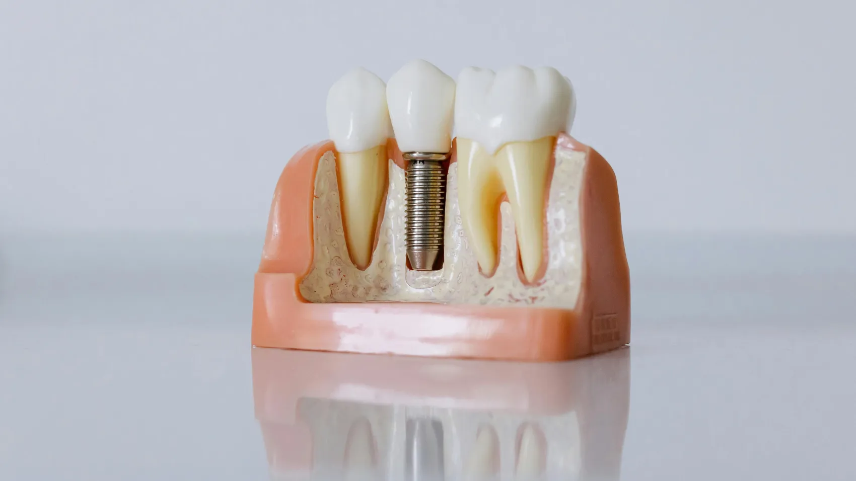 All-on-4 Dental Implants in Turkey: A Complete Guide for International Patients